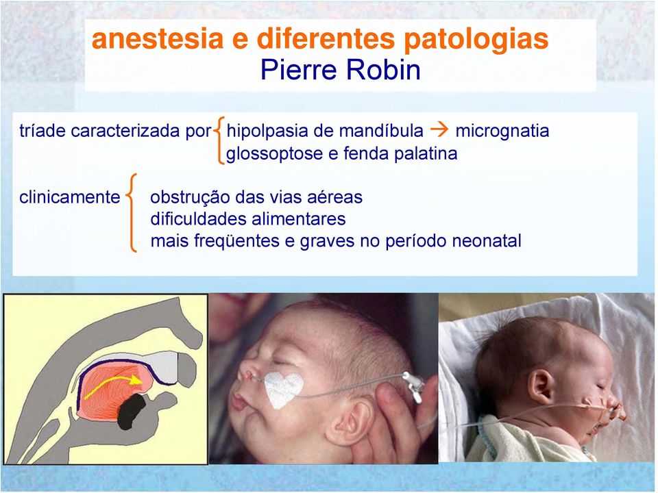 glossoptose e fenda palatina clinicamente obstrução das vias