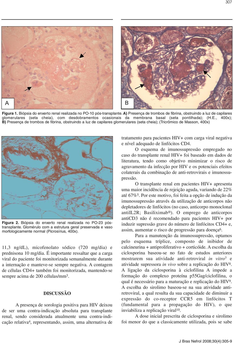 , 400x); B) Presença de trombos de fibrina, obstruindo a luz de capilares glomerulares (seta cheia); (Tricrômico de Masson, 400x) Figura 2. Biópsia do enxerto renal realizada no PO-23 póstransplante.