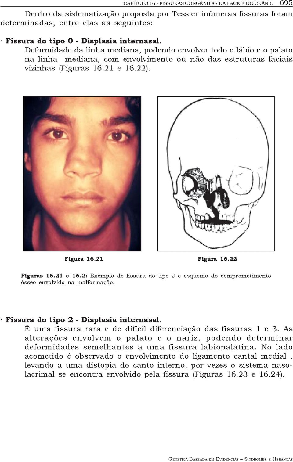 22 Figuras 16.21 e 16.2: Exemplo de fissura do tipo 2 e esquema do comprometimento ósseo envolvido na malformação. Fissura do tipo 2 - Displasia internasal.