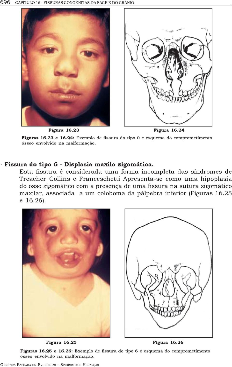 Esta fissura é considerada uma forma incompleta das síndromes de Treacher Collins e Franceschetti Apresenta-se como uma hipoplasia do osso zigomático