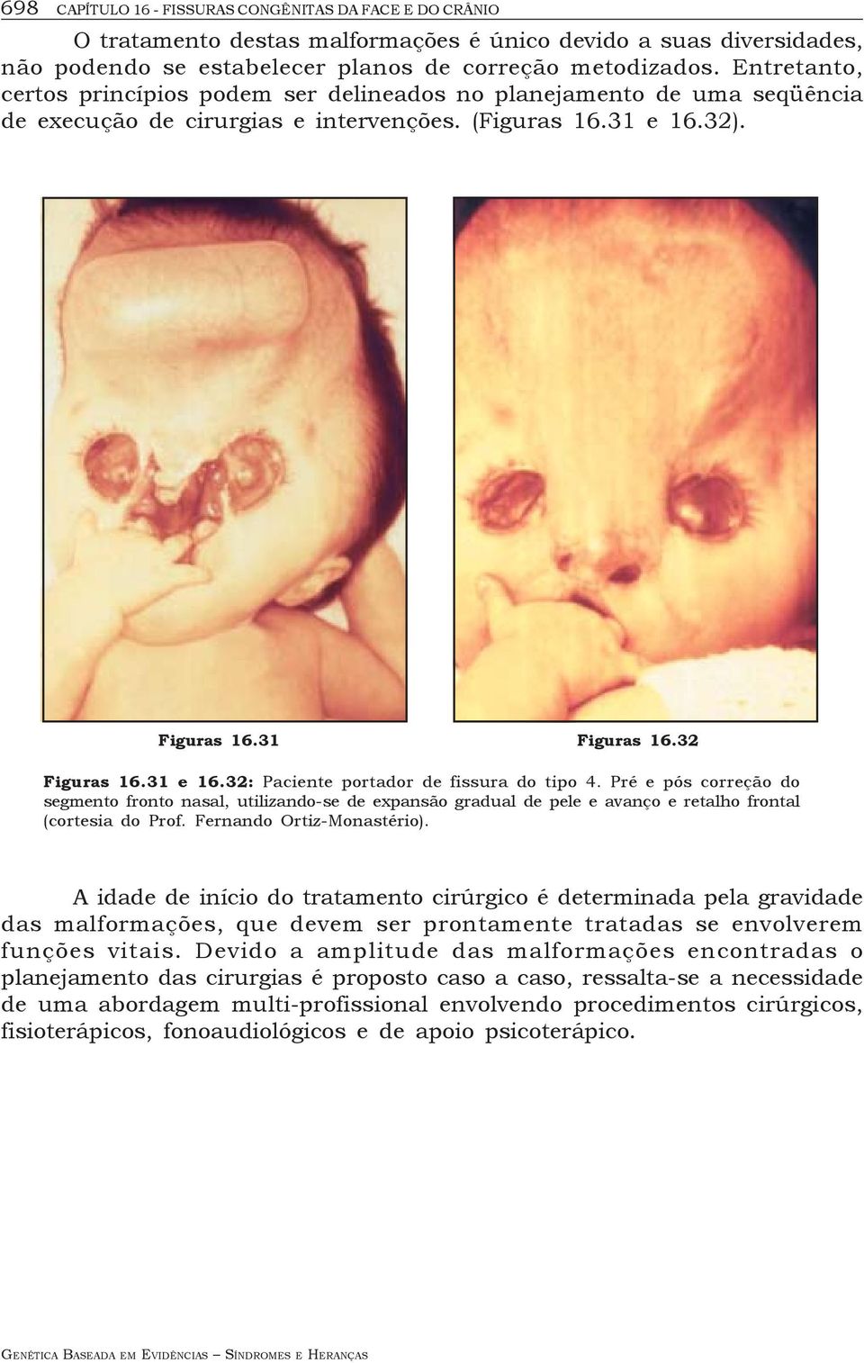 Pré e pós correção do segmento fronto nasal, utilizando-se de expansão gradual de pele e avanço e retalho frontal (cortesia do Prof. Fernando Ortiz-Monastério).