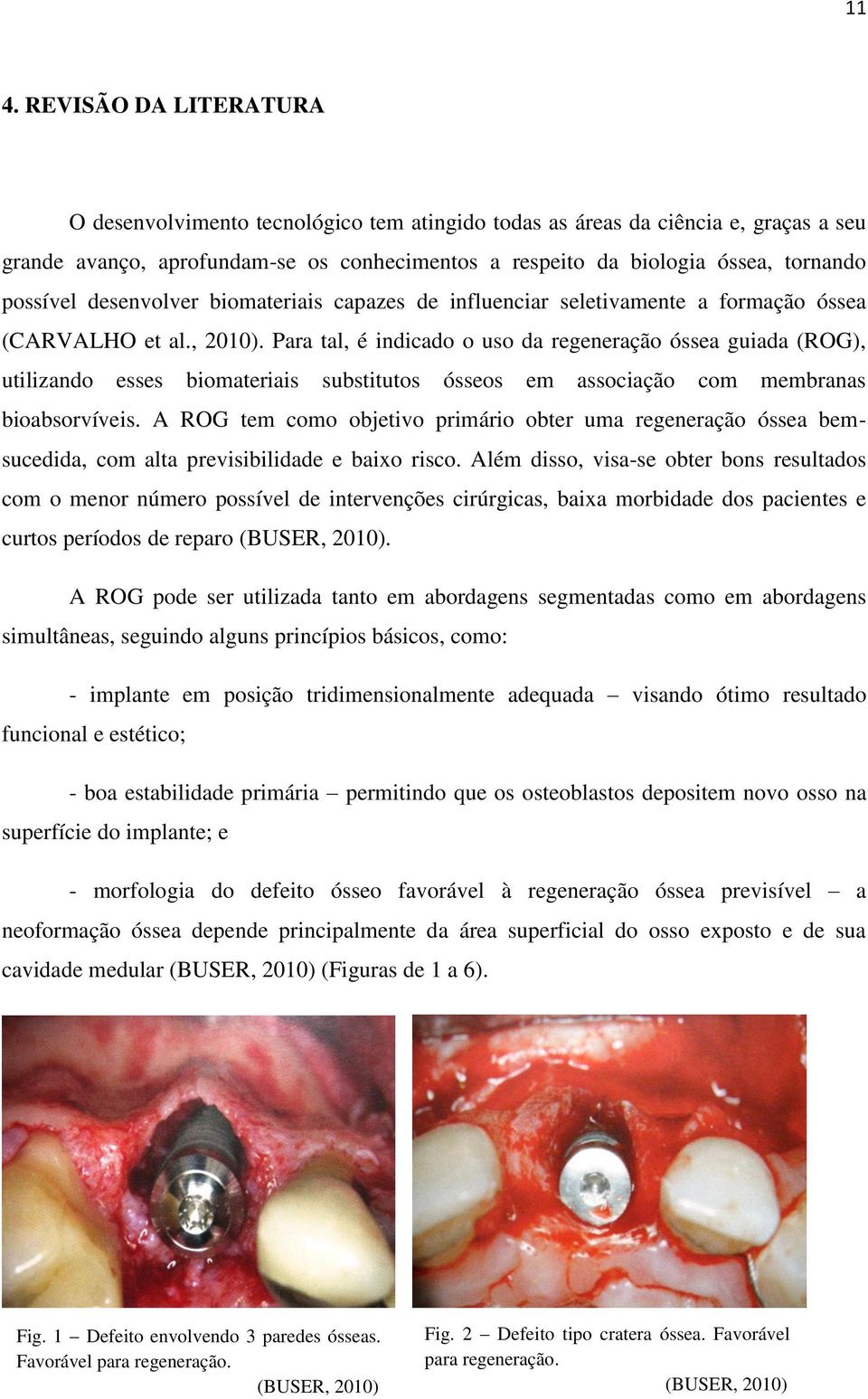 Para tal, é indicado o uso da regeneração óssea guiada (ROG), utilizando esses biomateriais substitutos ósseos em associação com membranas bioabsorvíveis.