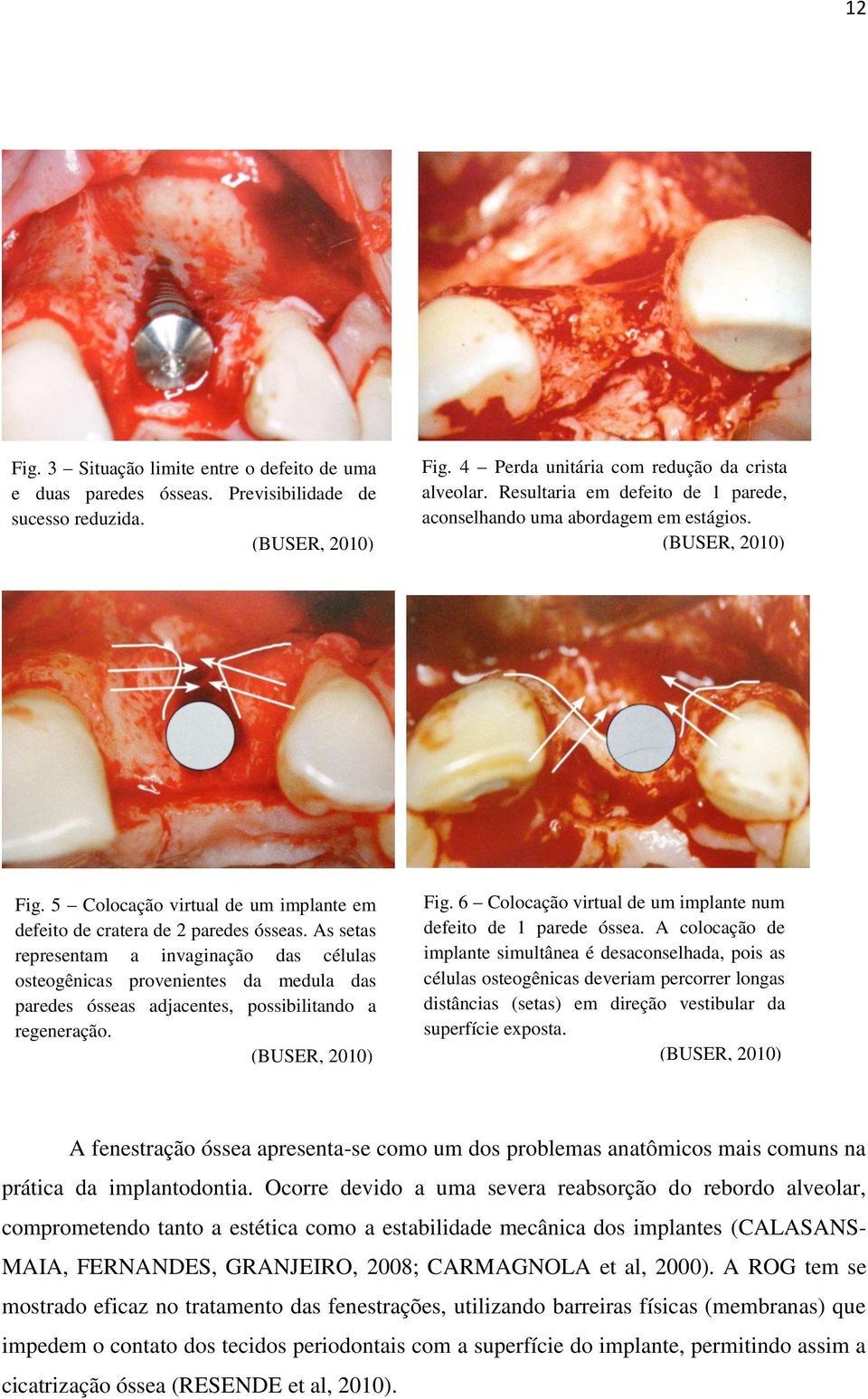 As setas representam a invaginação das células osteogênicas provenientes da medula das paredes ósseas adjacentes, possibilitando a regeneração. (BUSER, 2010) Fig.