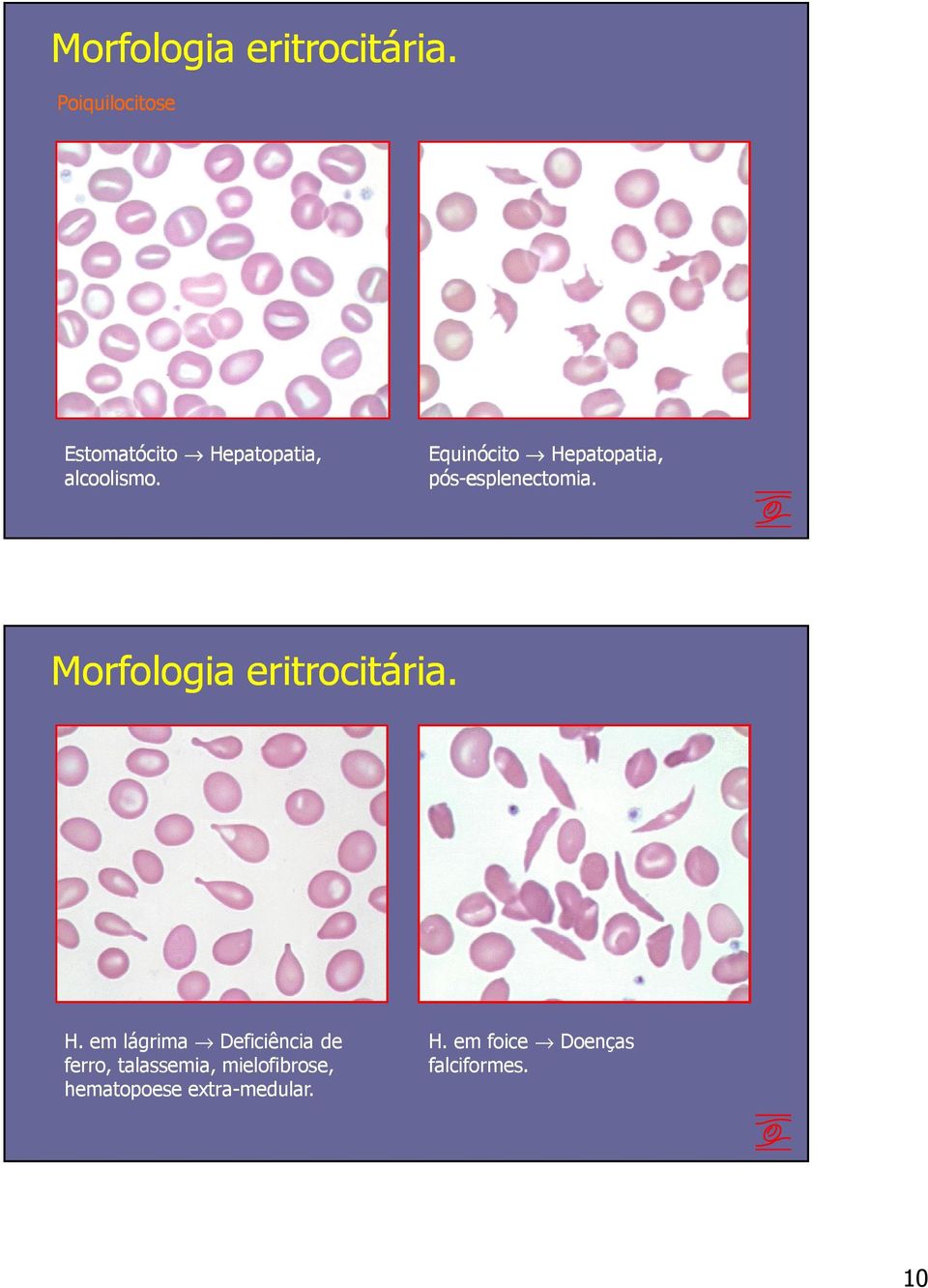 Equinócito Hepatopatia, pós-esplenectomia.  H.