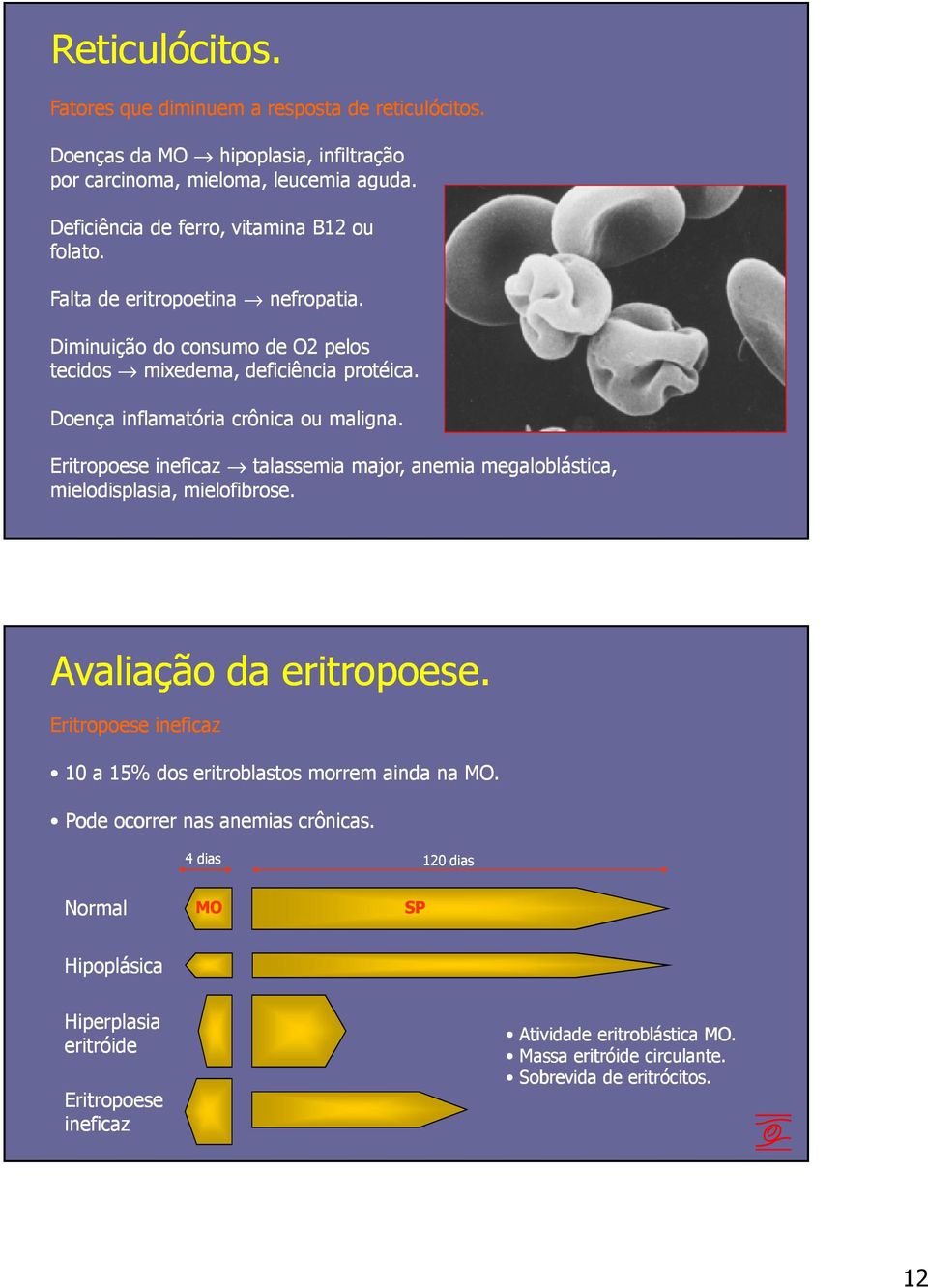 Doença inflamatória crônica ou maligna. Eritropoese ineficaz talassemia major, anemia megaloblástica, mielodisplasia, mielofibrose. Avaliação da eritropoese.