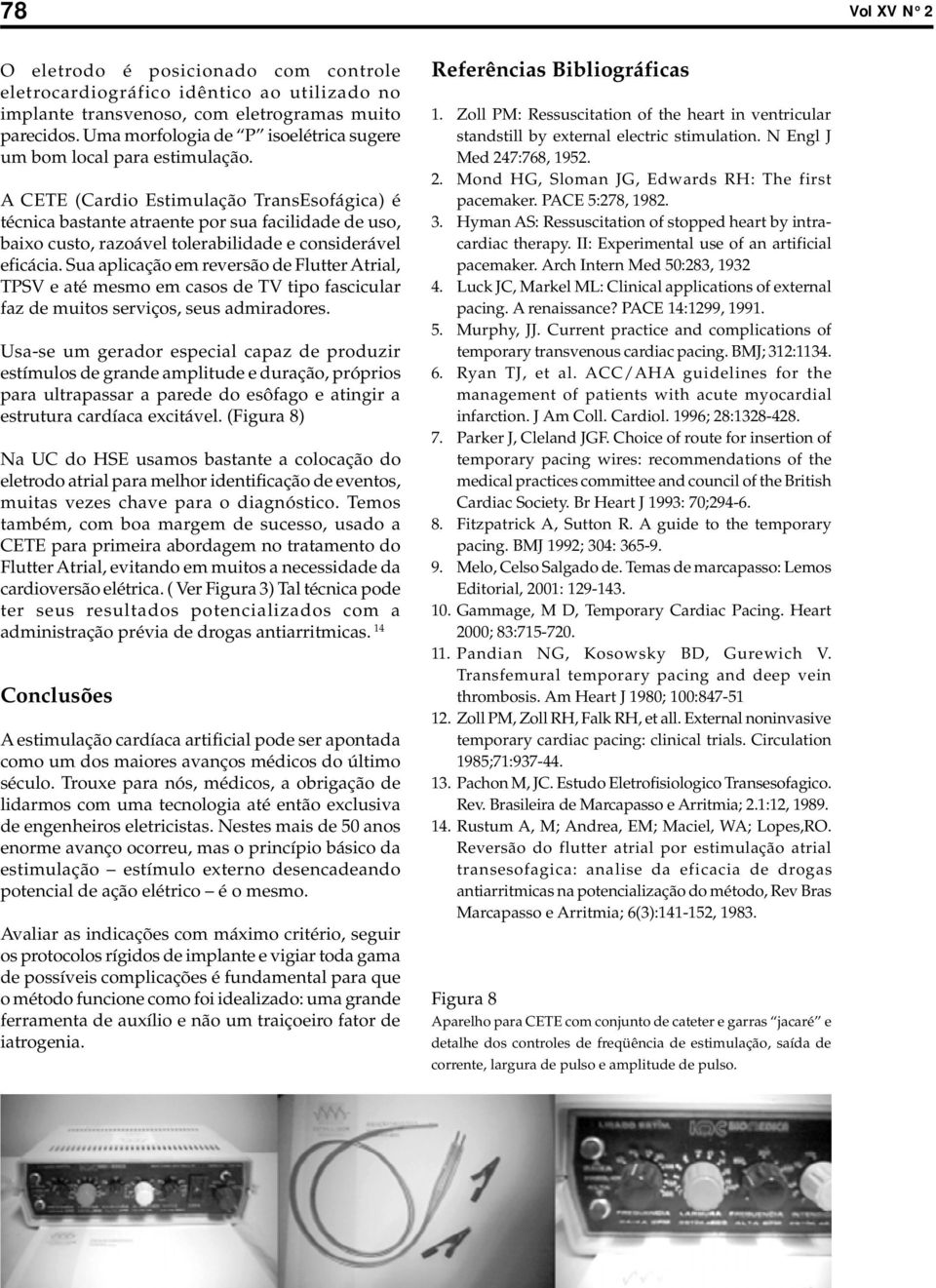 A CETE (Cardio Estimulação TransEsofágica) é técnica bastante atraente por sua facilidade de uso, baixo custo, razoável tolerabilidade e considerável eficácia.