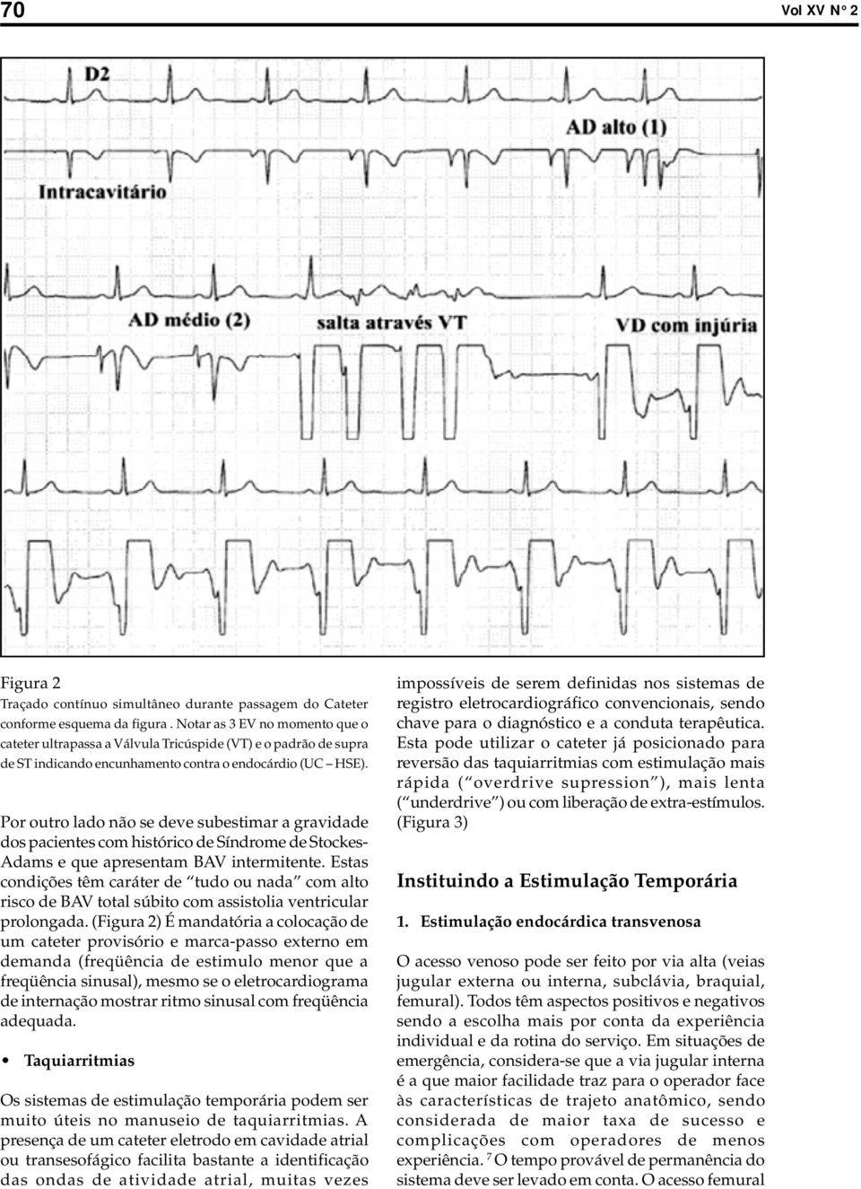 Por outro lado não se deve subestimar a gravidade dos pacientes com histórico de Síndrome de Stockes- Adams e que apresentam BAV intermitente.