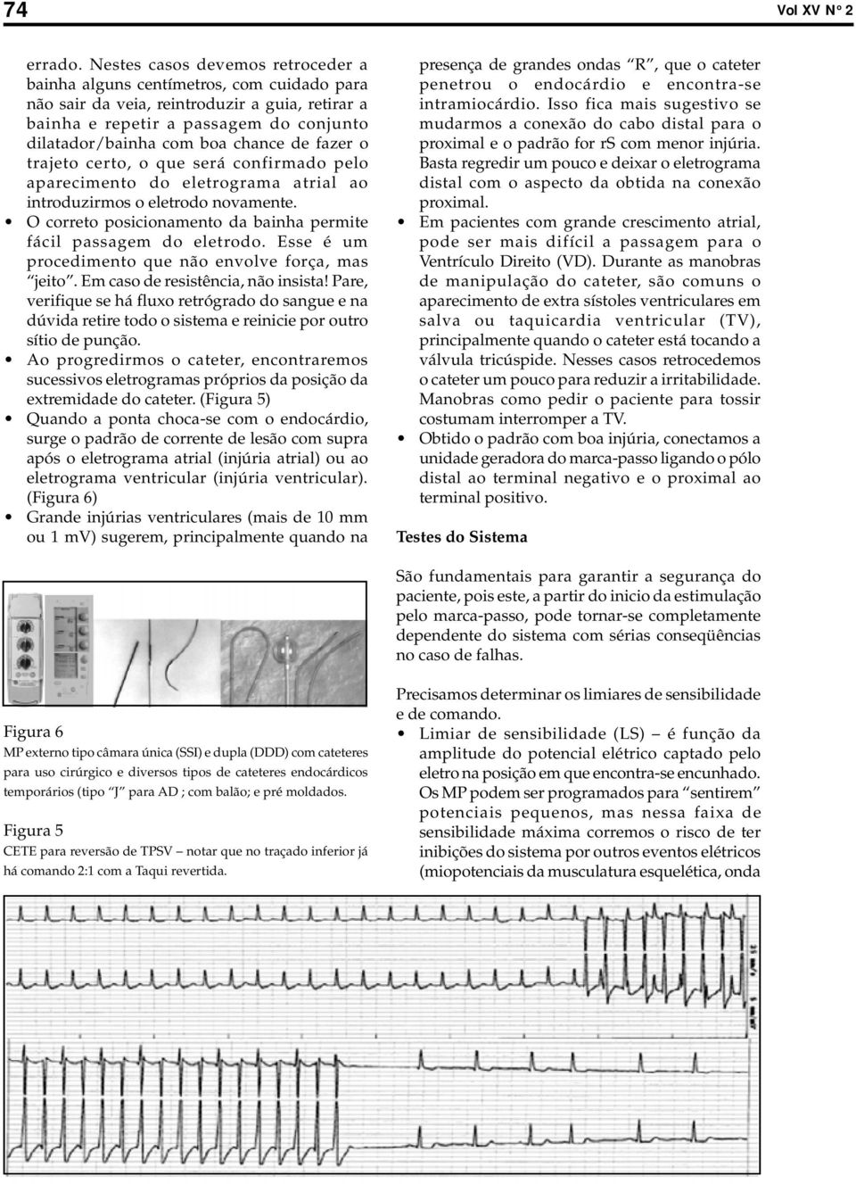 de fazer o trajeto certo, o que será confirmado pelo aparecimento do eletrograma atrial ao introduzirmos o eletrodo novamente. O correto posicionamento da bainha permite fácil passagem do eletrodo.