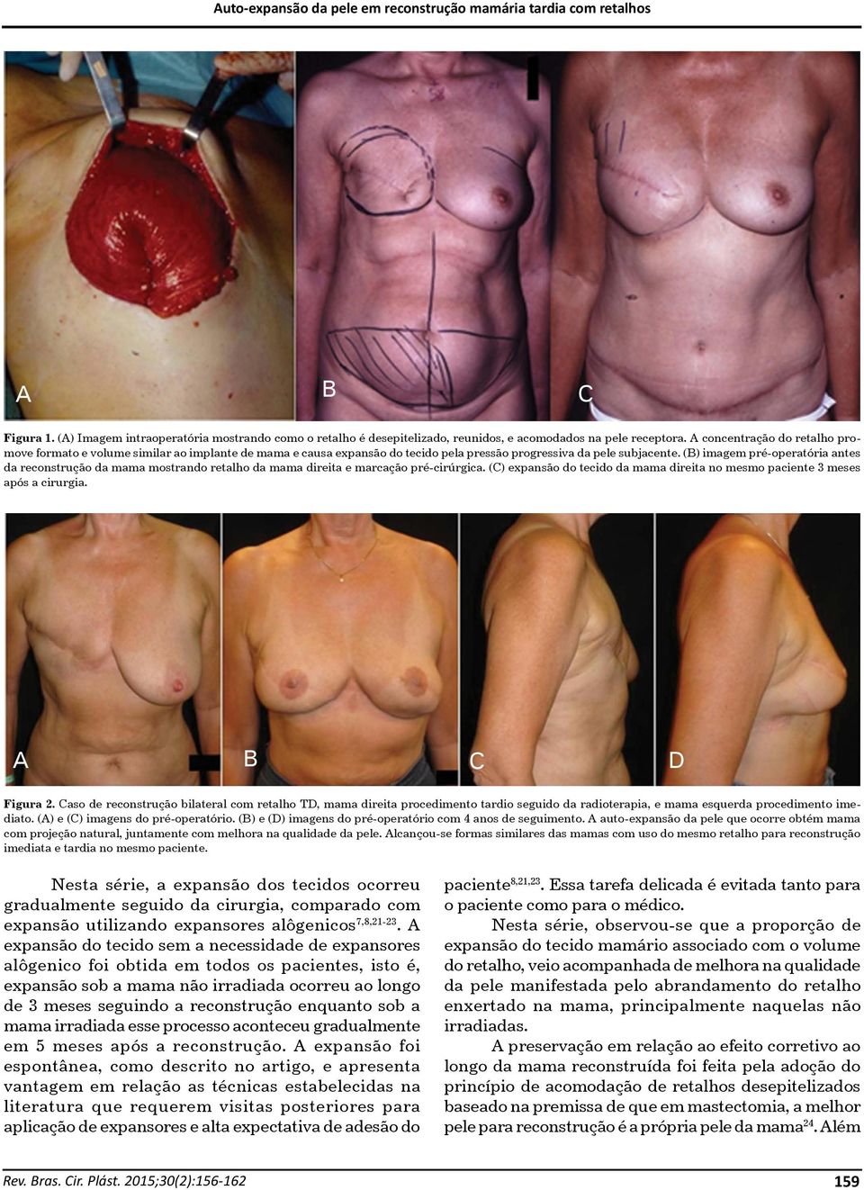 (B) imagem pré-operatória antes da reconstrução da mama mostrando retalho da mama direita e marcação pré-cirúrgica. (C) expansão do tecido da mama direita no mesmo paciente 3 meses após a cirurgia.