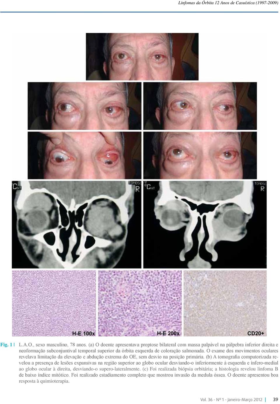 O exame dos movimentos oculares revelava limitação da elevação e abdução extrema do OE, sem desvio na posição primária.