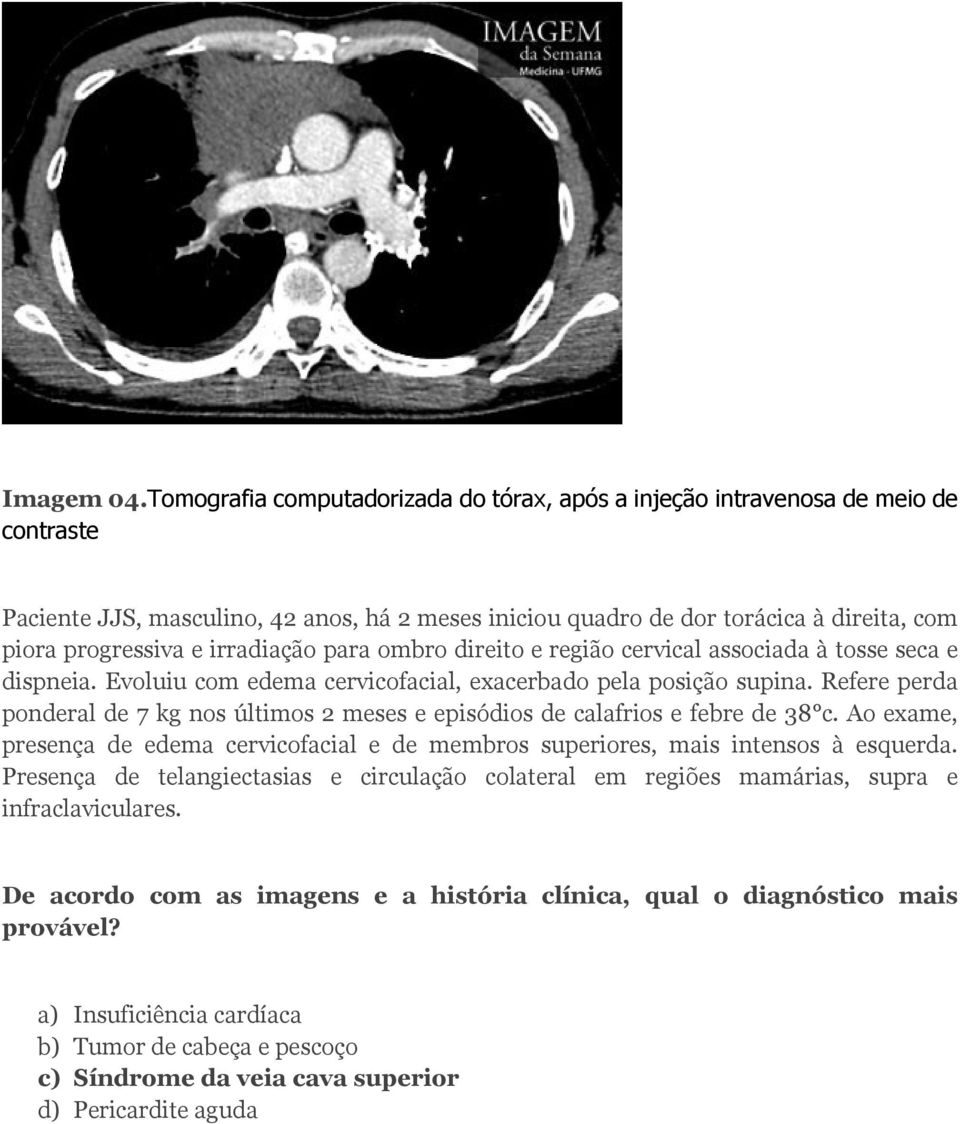 irradiação para ombro direito e região cervical associada à tosse seca e dispneia. Evoluiu com edema cervicofacial, exacerbado pela posição supina.