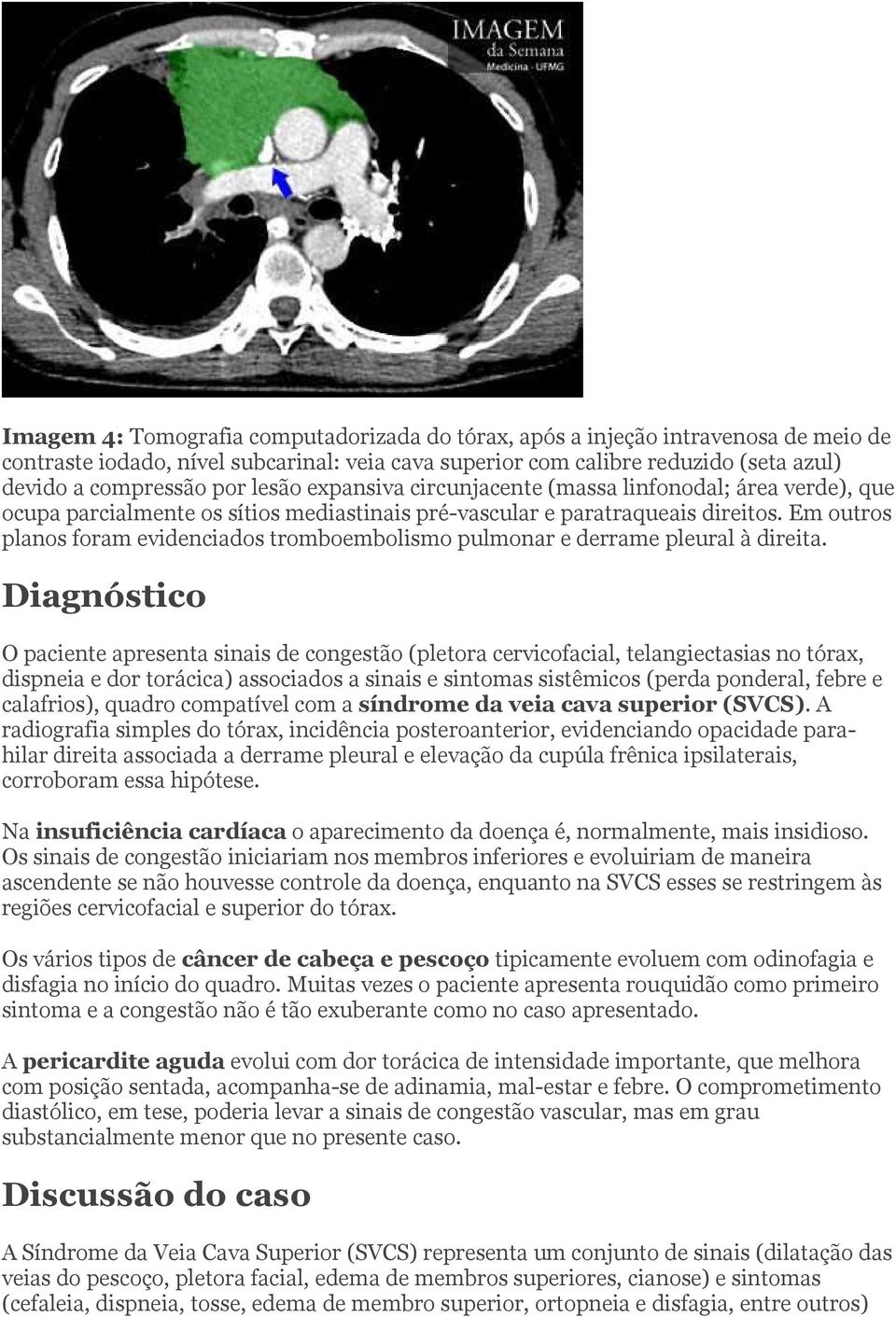 Em outros planos foram evidenciados tromboembolismo pulmonar e derrame pleural à direita.