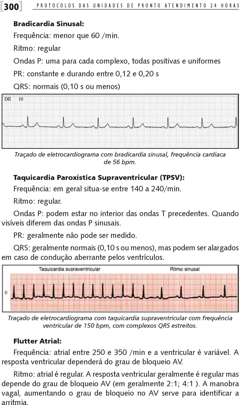 sinusal, frequência cardíaca de 56 bpm. Taquicardia Paroxística Supraventricular (TPSV): Frequência: em geral situa-se entre 140 a 240/min. Ritmo: regular.
