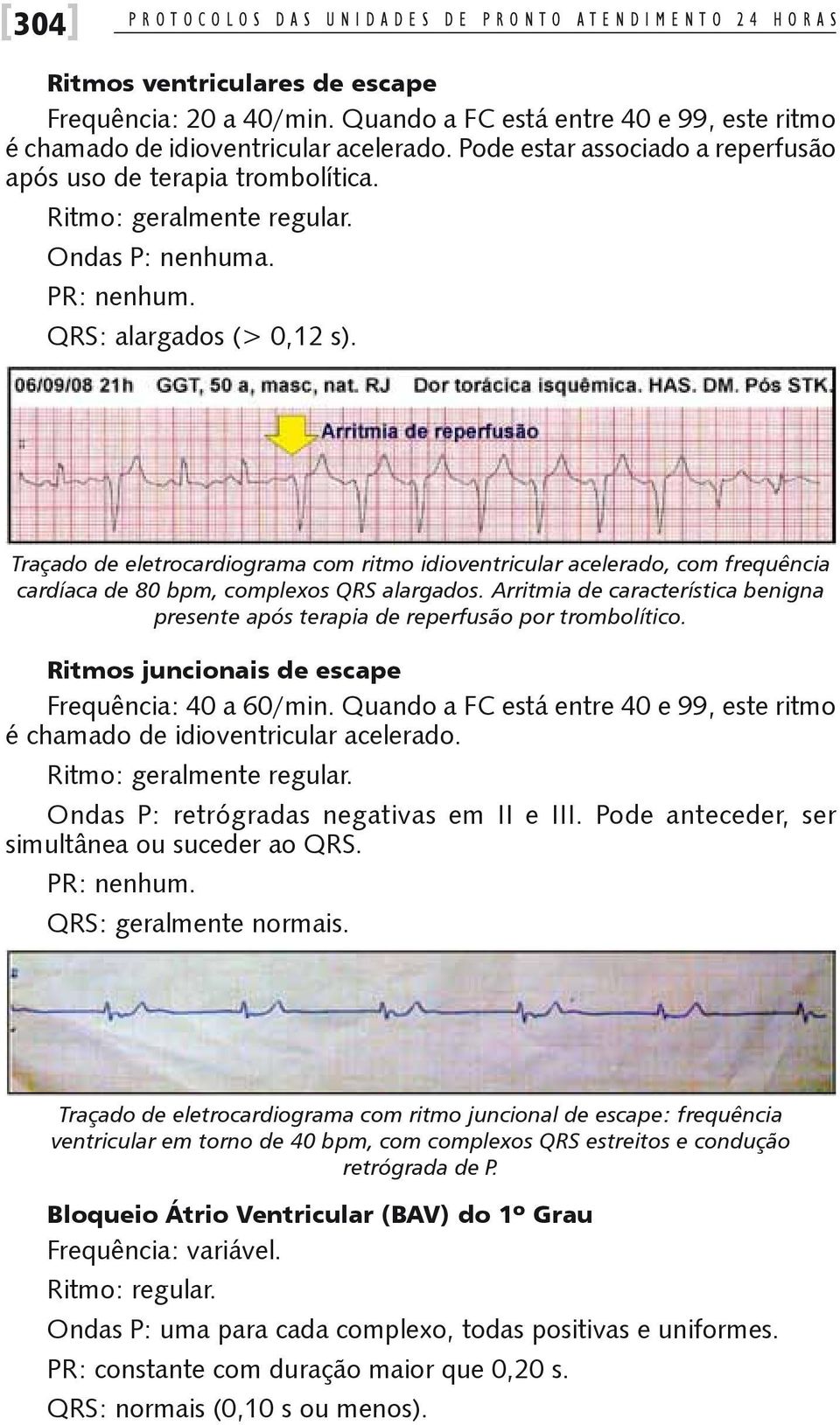 PR: nenhum. QRS: alargados (> 0,12 s). Traçado de eletrocardiograma com ritmo idioventricular acelerado, com frequência cardíaca de 80 bpm, complexos QRS alargados.