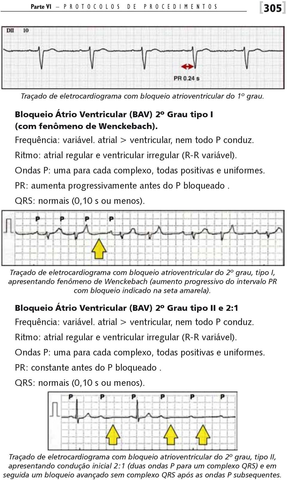 Ritmo: atrial regular e ventricular irregular (R-R variável). Ondas P: uma para cada complexo, todas positivas e uniformes. PR: aumenta progressivamente antes do P bloqueado.