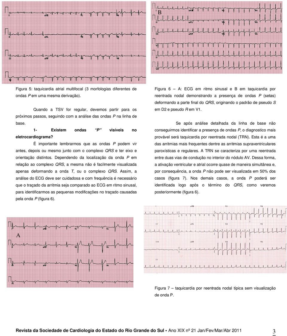 próximos passos, seguindo com a análise das ondas P na linha de Se após análise detalhada da linha de base não base. 1- Existem ondas P visíveis no eletrocardiograma?