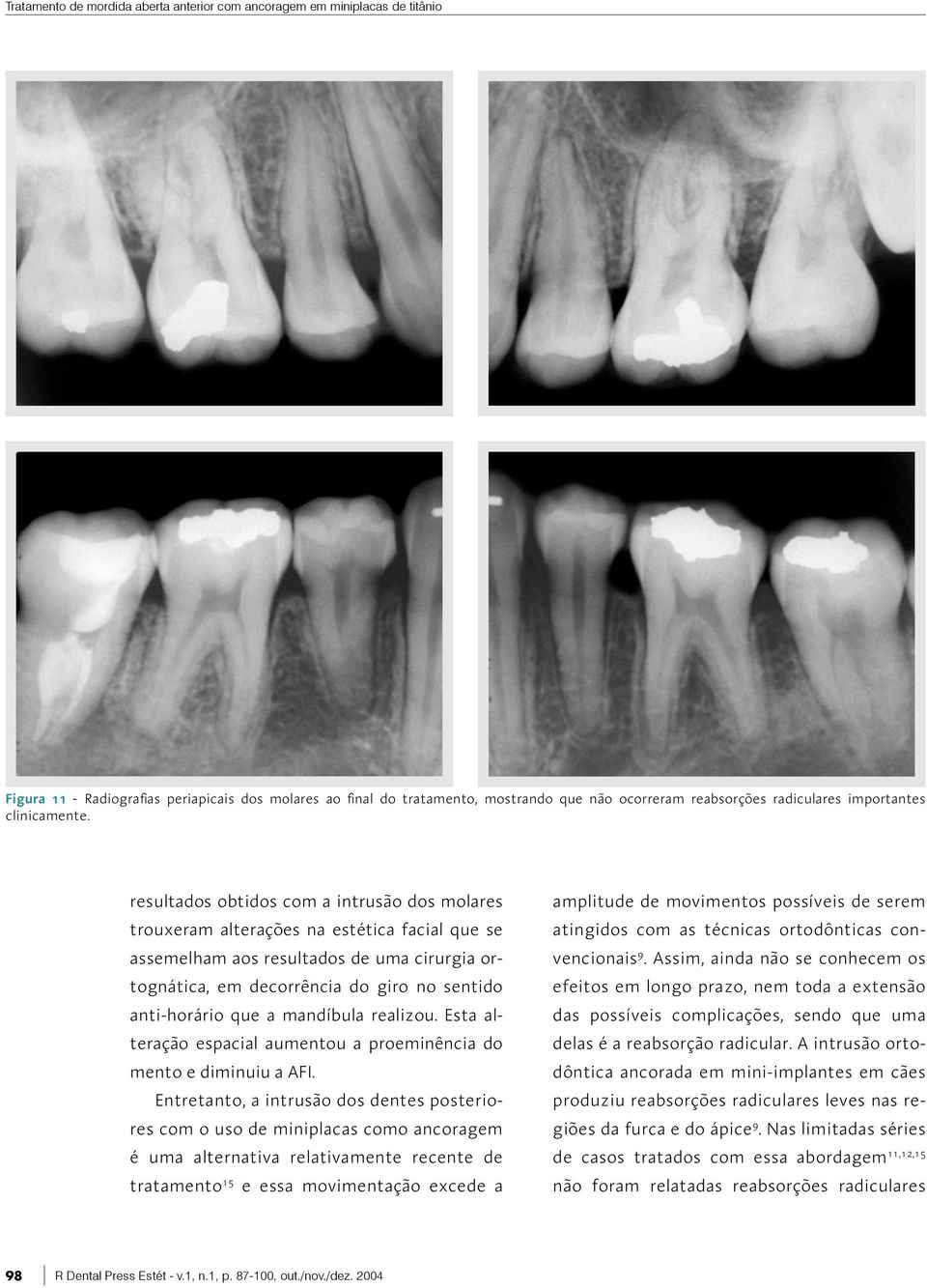 resultados obtidos com a intrusão dos molares trouxeram alterações na estética facial que se assemelham aos resultados de uma cirurgia ortognática, em decorrência do giro no sentido anti-horário que