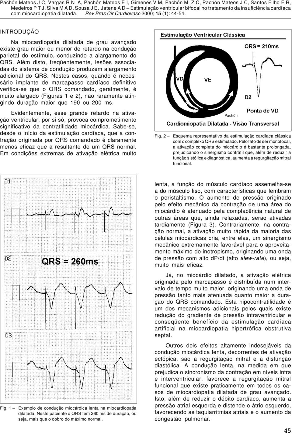 Nestes casos, quando é necessário implante de marcapasso cardíaco definitivo verifica-se que o QRS comandado, geralmente, é muito alargado (Figuras 1 e 2), não raramente atingindo duração maior que