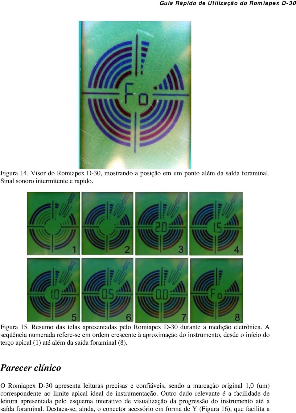 A seqüência numerada refere-se em ordem crescente à aproximação do instrumento, desde o início do terço apical (1) até além da saída foraminal (8).