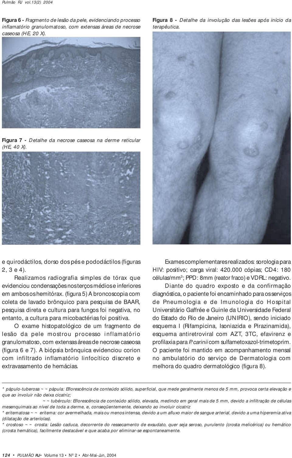 e quirodáctilos, dorso dos pés e pododáctilos (figuras 2, 3 e 4). Realizamos radiografia simples de tórax que evidenciou condensações nos terços médios e inferiores em ambos os hemitórax.