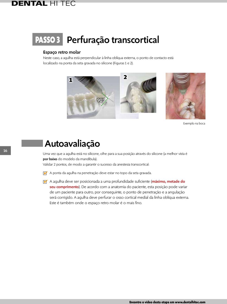 Validar 2 pontos, de modo a garantir o sucesso da anestesia transcortical: A ponta da agulha na penetração deve estar no topo da seta gravada.