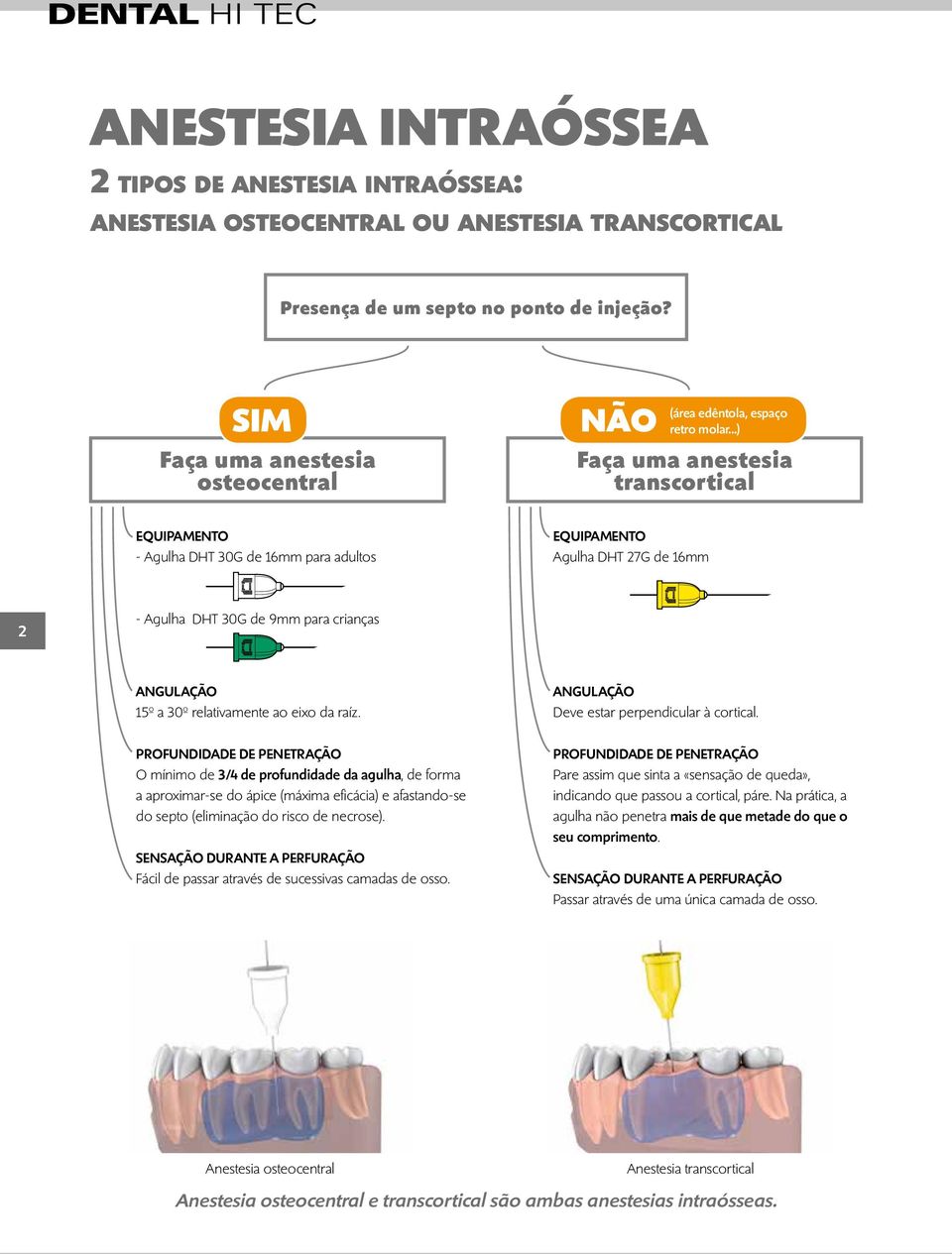 ..) Faça uma anestesia transcortical EQUIPAMENTO - Agulha DHT 30G de 16mm para adultos EQUIPAMENTO Agulha DHT 27G de 16mm 2 - Agulha DHT 30G de 9mm para crianças ANGULAÇÃO 15º a 30º relativamente ao