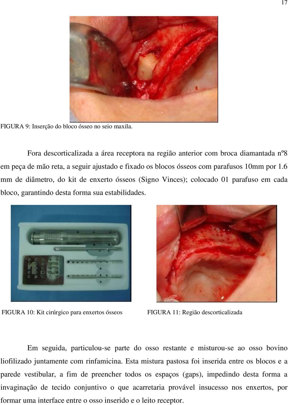 6 mm de diâmetro, do kit de enxerto ósseos (Signo Vinces); colocado 01 parafuso em cada bloco, garantindo desta forma sua estabilidades.