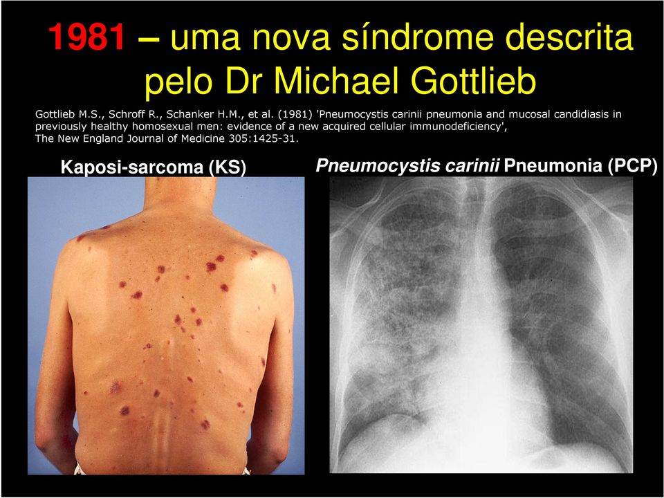 (1981) 'Pneumocystis carinii pneumonia and mucosal candidiasis in previously healthy