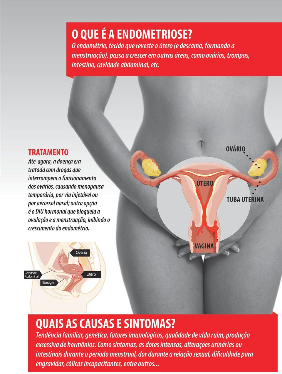 que bloqueia a ovulação e a menstruação, inibindo o crescimento do endométrio. Ovário ÚTERO VAGINA OVÁRIO TUBA UTERINA Cavidade Abdominal Bexiga Útero QUAIS AS CAUSAS E SINTOMAS?