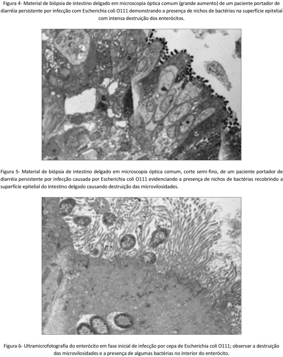 Figura 5- Material de biópsia de intestino delgado em microscopia óptica comum, corte semi-fino, de um paciente portador de diarréia persistente por infecção causada por Escherichia coli O111