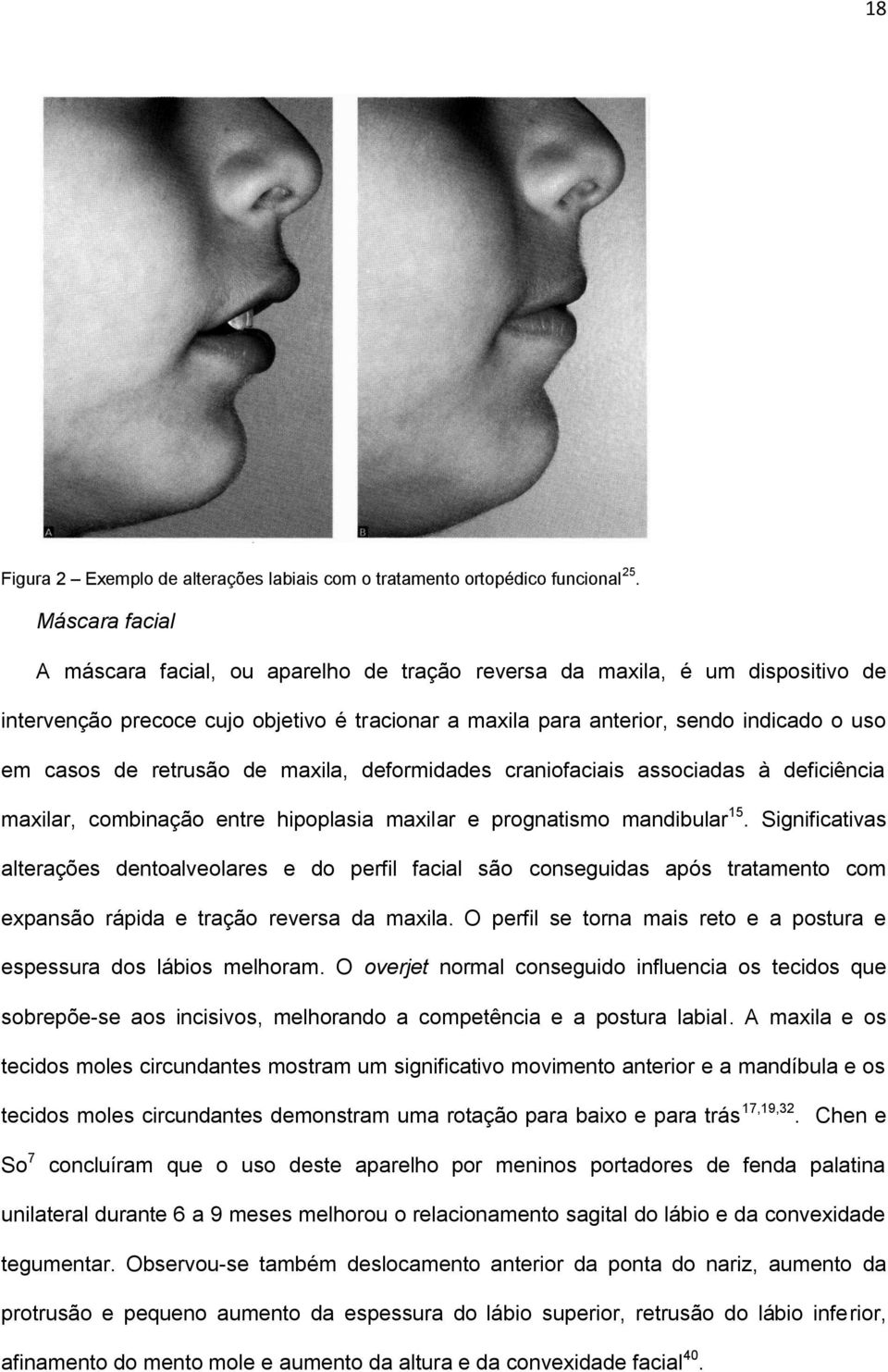 retrusão de maxila, deformidades craniofaciais associadas à deficiência maxilar, combinação entre hipoplasia maxilar e prognatismo mandibular 15.