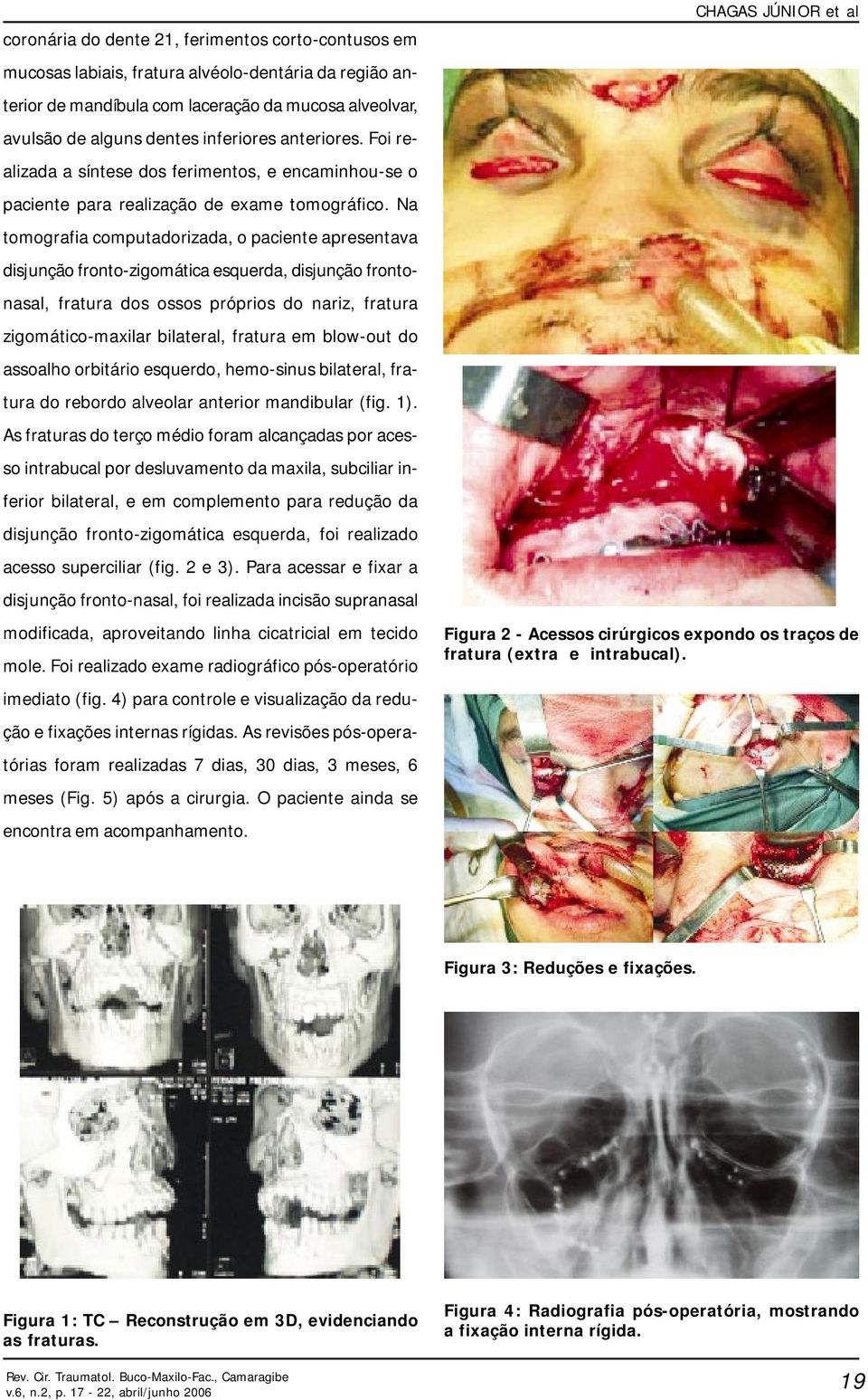 Na tomografia computadorizada, o paciente apresentava disjunção fronto-zigomática esquerda, disjunção frontonasal, fratura dos ossos próprios do nariz, fratura zigomático-maxilar bilateral, fratura