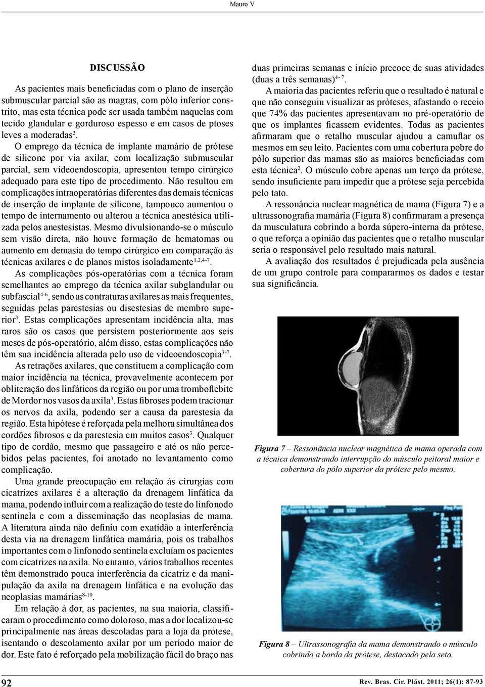 O emprego da técnica de implante mamário de prótese de silicone por via axilar, com localização submuscular parcial, sem videoendoscopia, apresentou tempo cirúrgico adequado para este tipo de