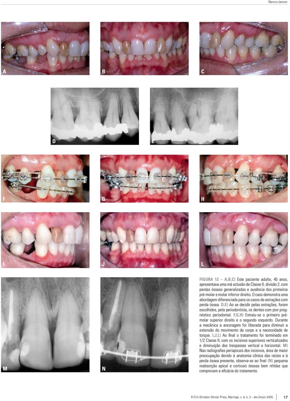 D,E) Ao se decidir pelas extrações, foram escolhidos, pela periodontista, os dentes com pior prognóstico periodontal. F,G,H) Extraiu-se o primeiro prémolar superior direito e o segundo esquerdo.