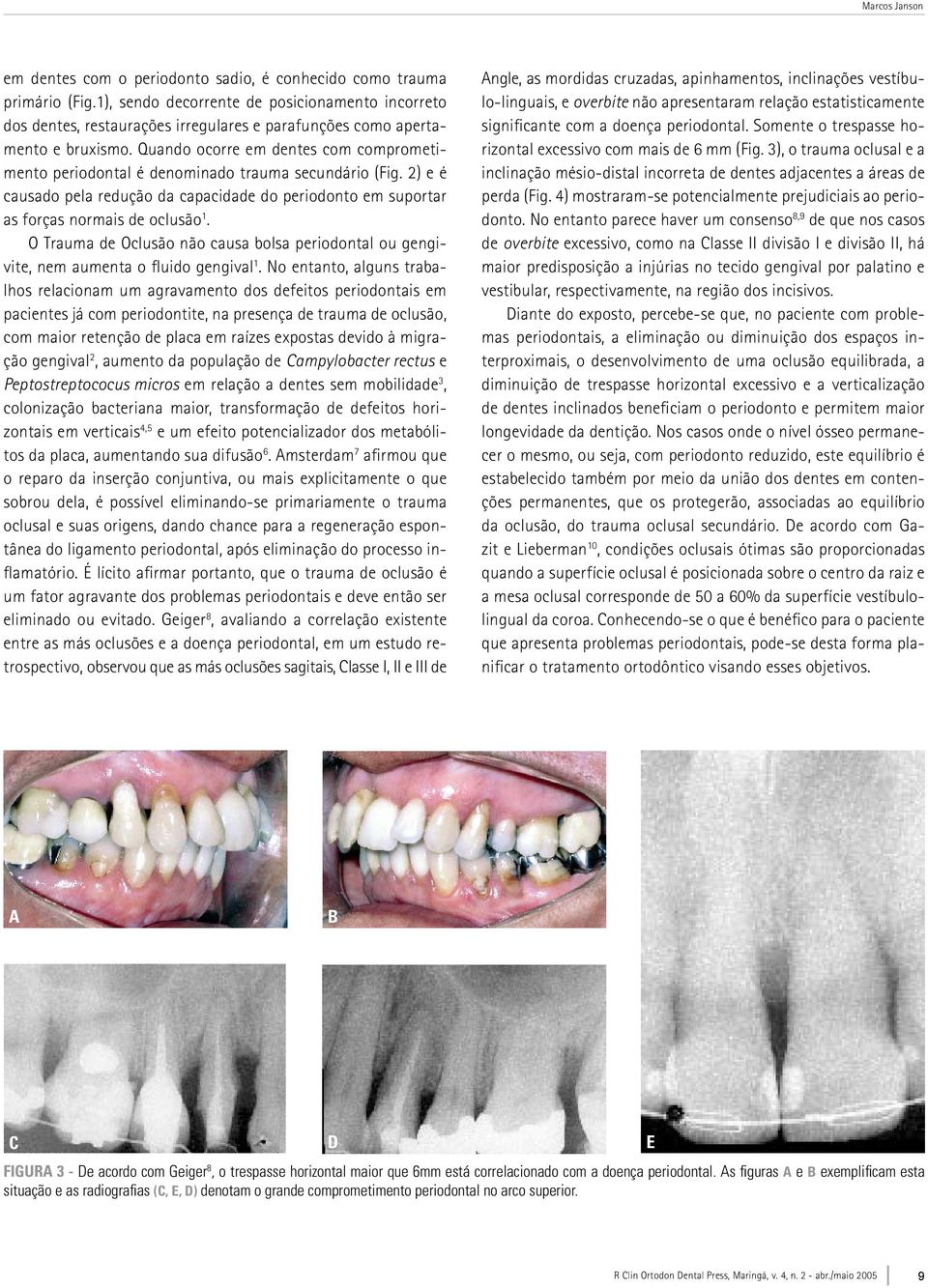 Quando ocorre em dentes com comprometimento periodontal é denominado trauma secundário (Fig. 2) e é causado pela redução da capacidade do periodonto em suportar as forças normais de oclusão 1.