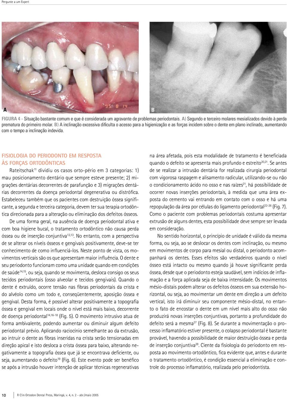 b Fisiologia do periodonto em resposta às forças ortodônticas Rateitschak 11 dividiu os casos orto-pério em 3 categorias: 1) mau posicionamento dentário que sempre esteve presente; 2) migrações
