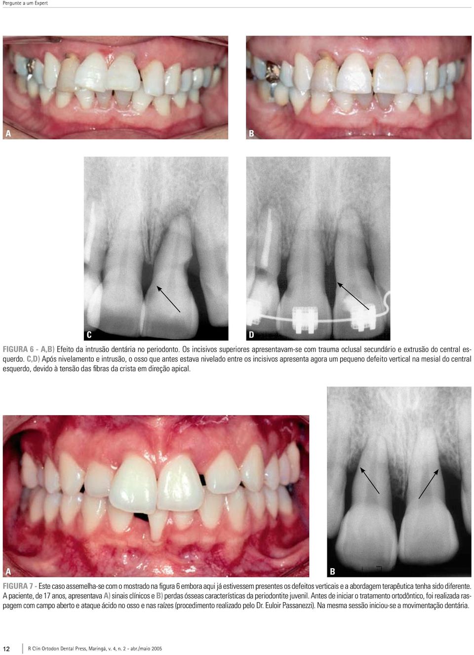 em direção apical. d a Figura 7 - Este caso assemelha-se com o mostrado na figura 6 embora aqui já estivessem presentes os defeitos verticais e a abordagem terapêutica tenha sido diferente.