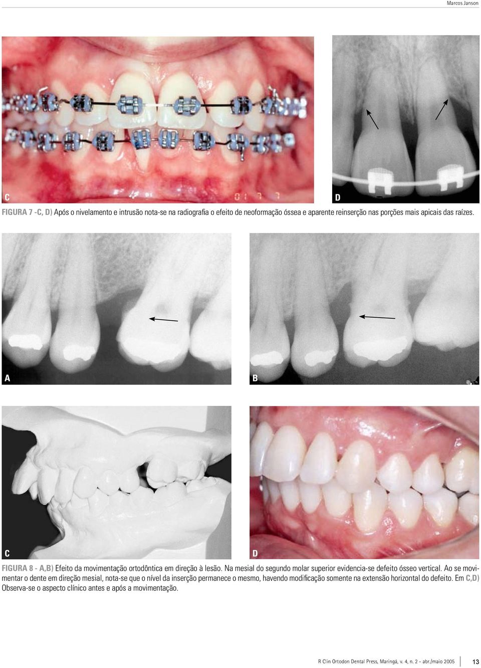 Na mesial do segundo molar superior evidencia-se defeito ósseo vertical.
