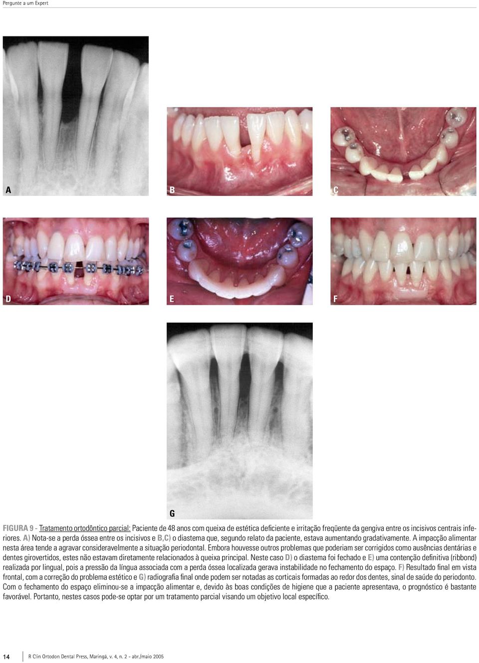 A impacção alimentar nesta área tende a agravar consideravelmente a situação periodontal.