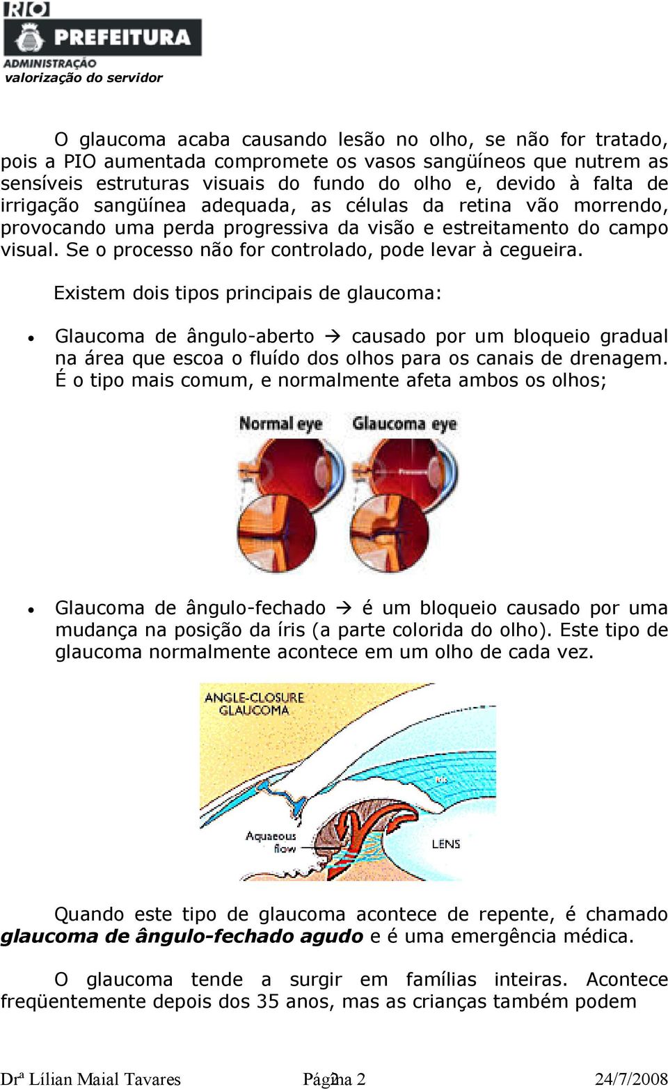 Existem dois tipos principais de glaucoma: Glaucoma de ângulo-aberto causado por um bloqueio gradual na área que escoa o fluído dos olhos para os canais de drenagem.