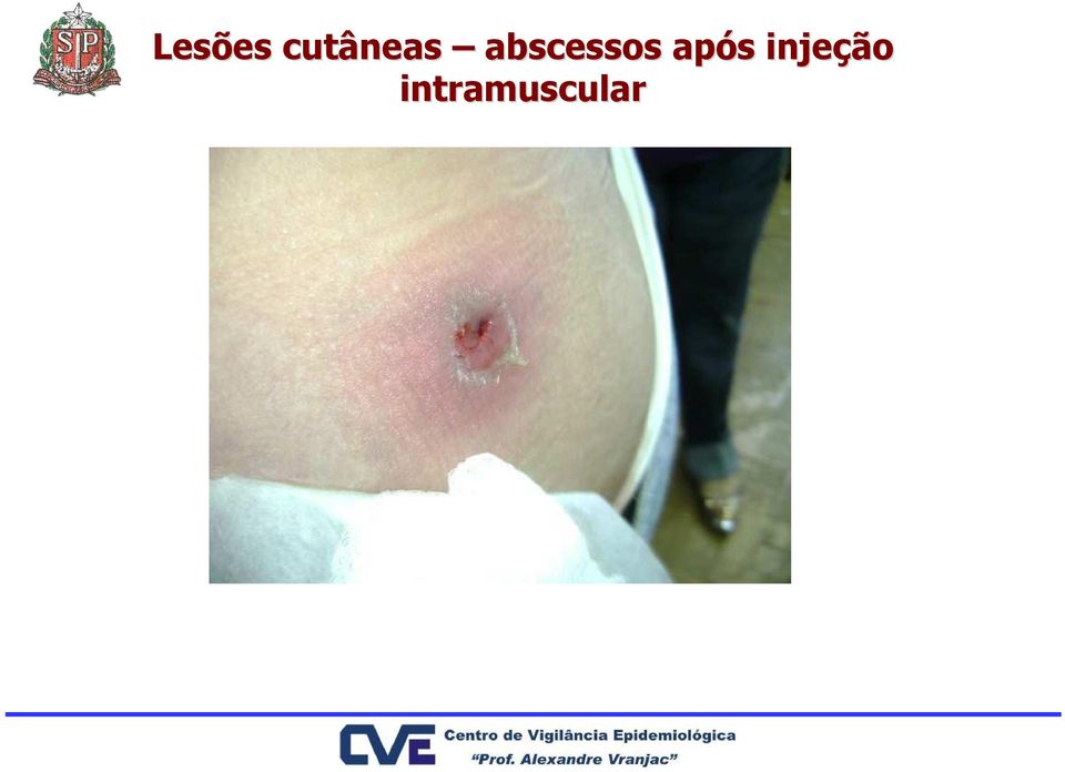 abscessos após