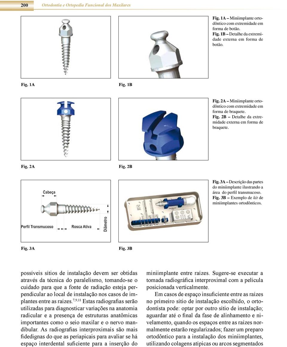 3A Descrição das partes do miniimplante ilustrando a área do perfil transmucoso. Fig. 3B Exemplo de kit de miniimplantes ortodônticos. Fig. 3A Fig.