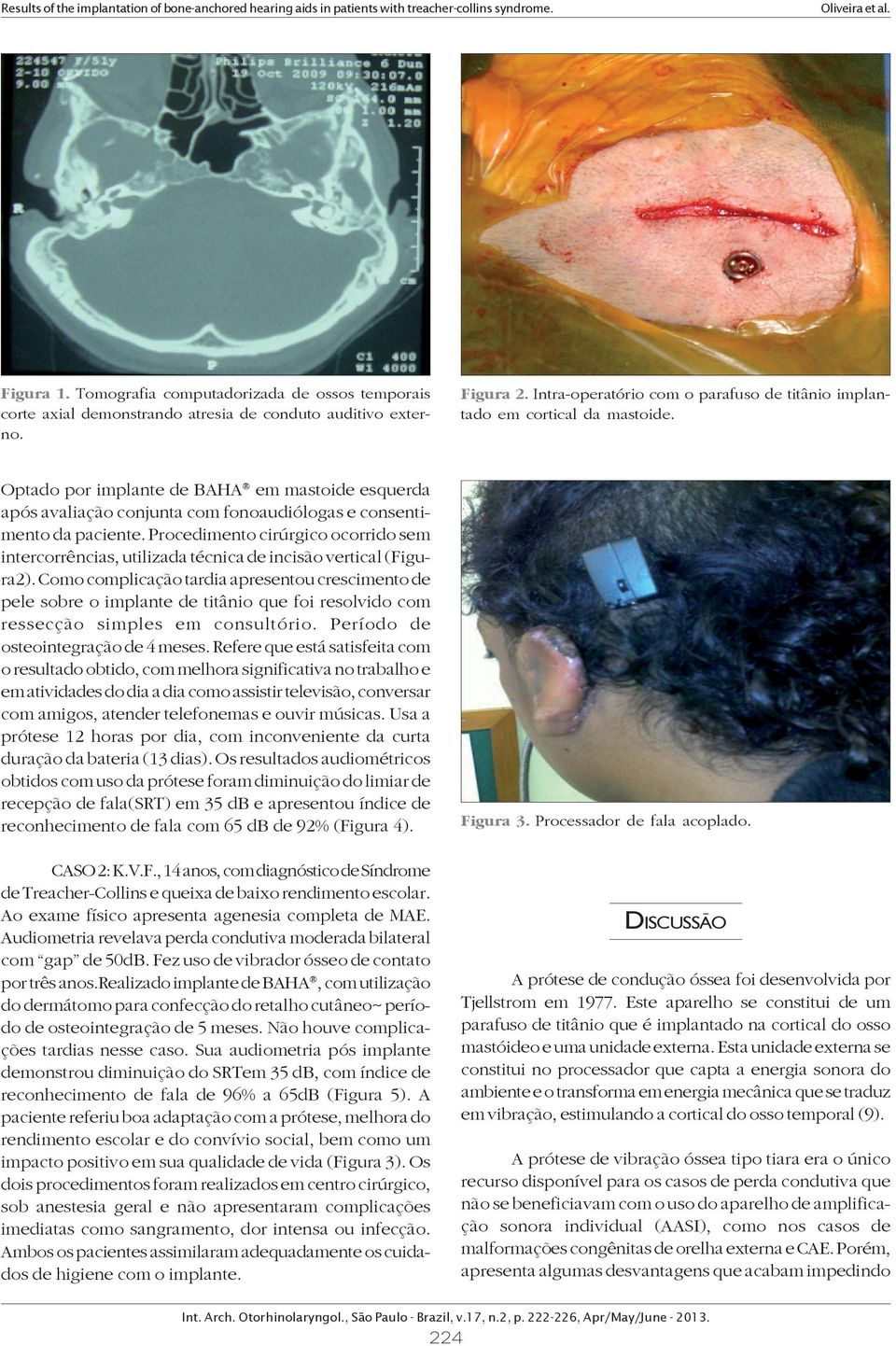 Optado por implante de BAHA em mastoide esquerda após avaliação conjunta com fonoaudiólogas e consentimento da paciente.