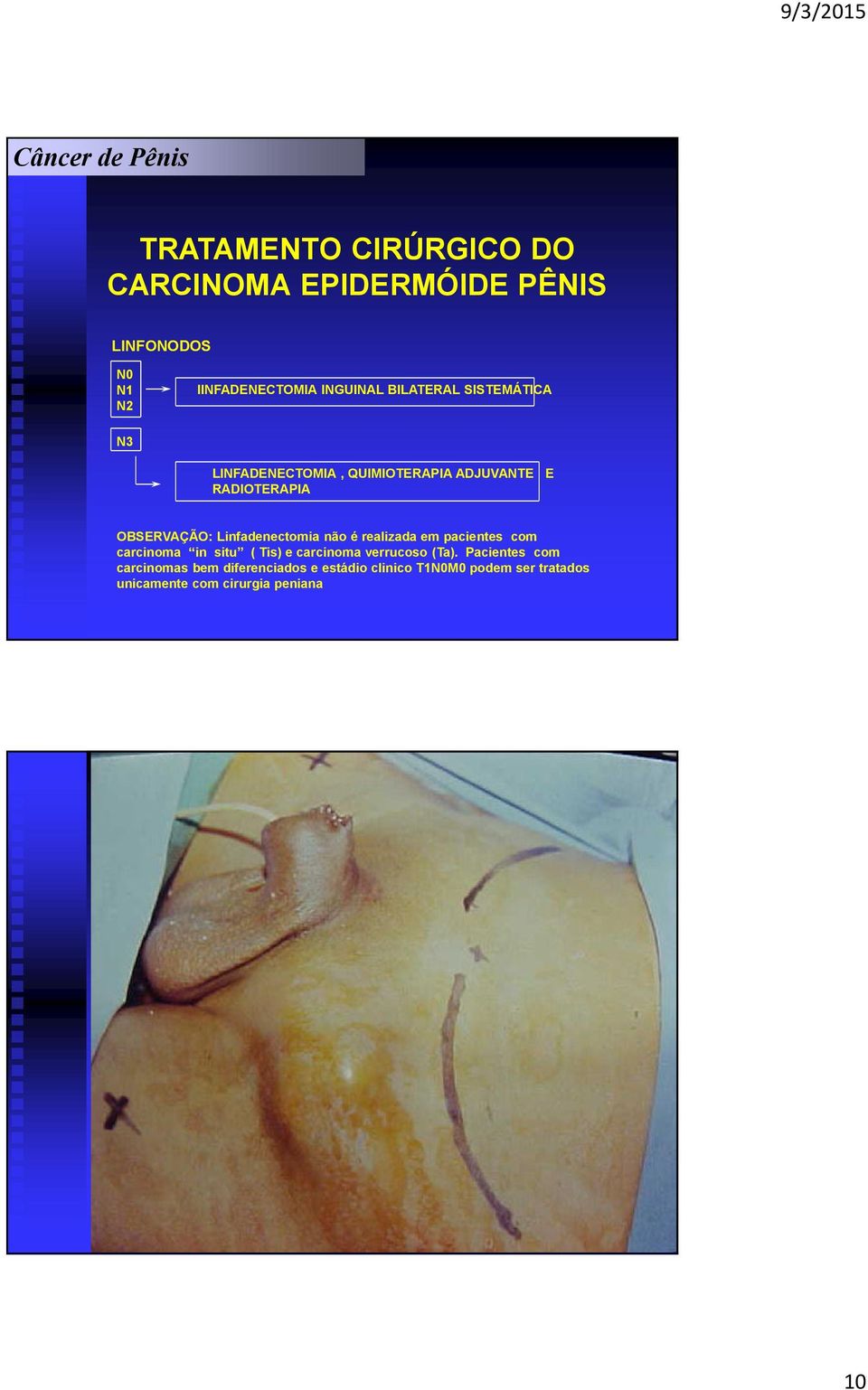 Linfadenectomia não é realizada em pacientes com carcinoma in situ ( Tis) e carcinoma verrucoso (Ta).