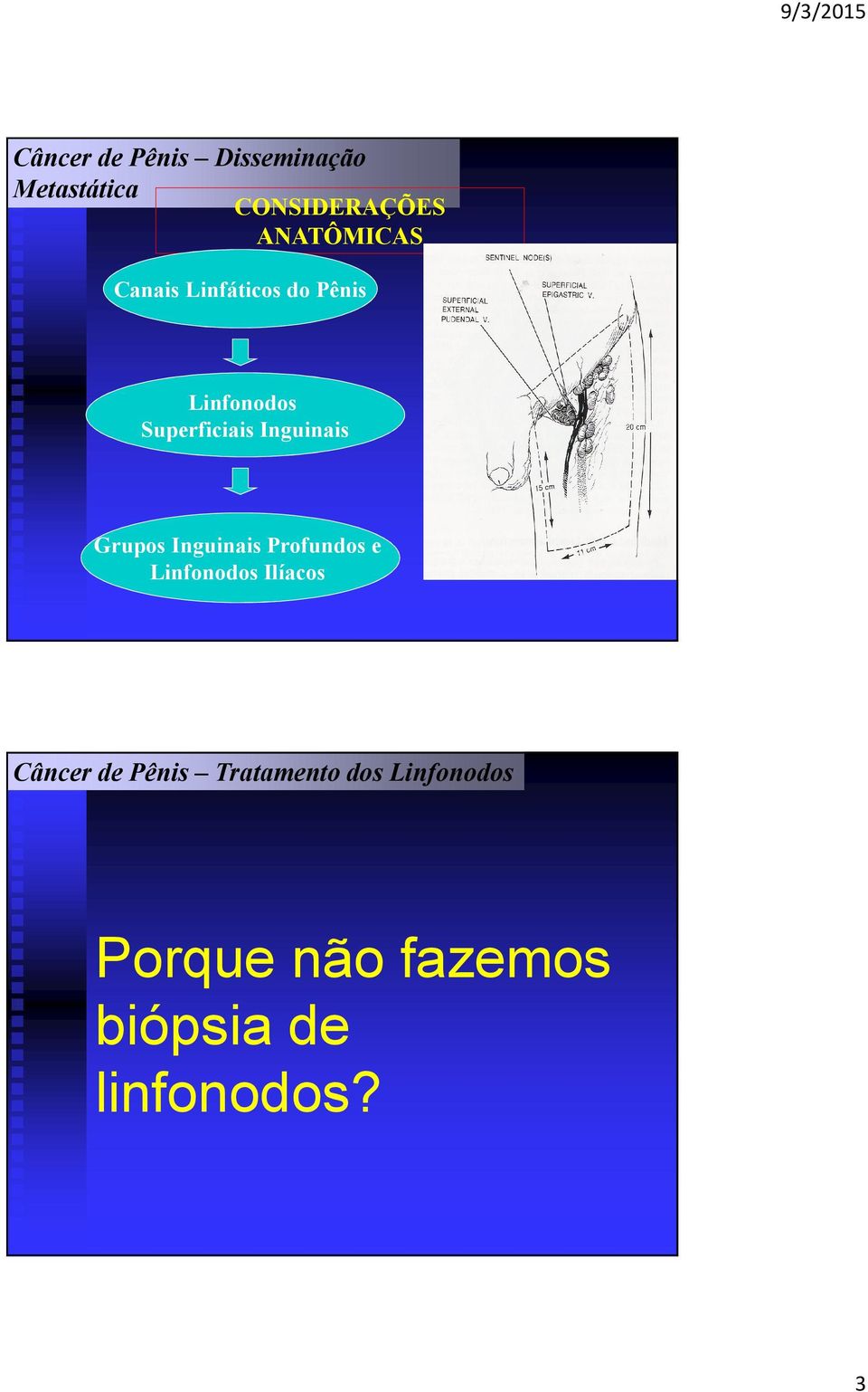 Inguinais Grupos Inguinais Profundos e LinfonodosIlíacos Câncer