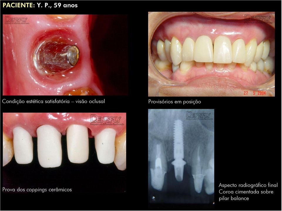 dos coppings cerâmicos Aspecto