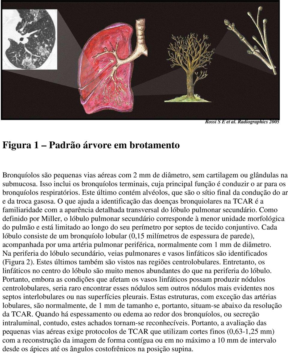 O que ajuda a identificação das doenças bronquiolares na TCAR é a familiaridade com a aparência detalhada transversal do lóbulo pulmonar secundário.