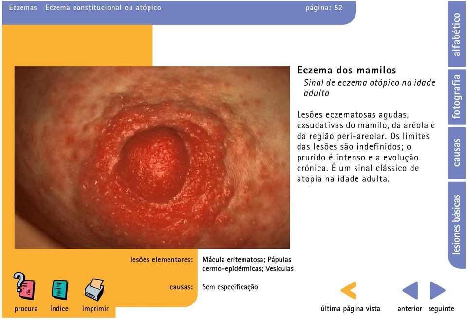 peri-areolar. Os limites das lesões são indefinidos; o prurido é intenso e a evolução crónica.