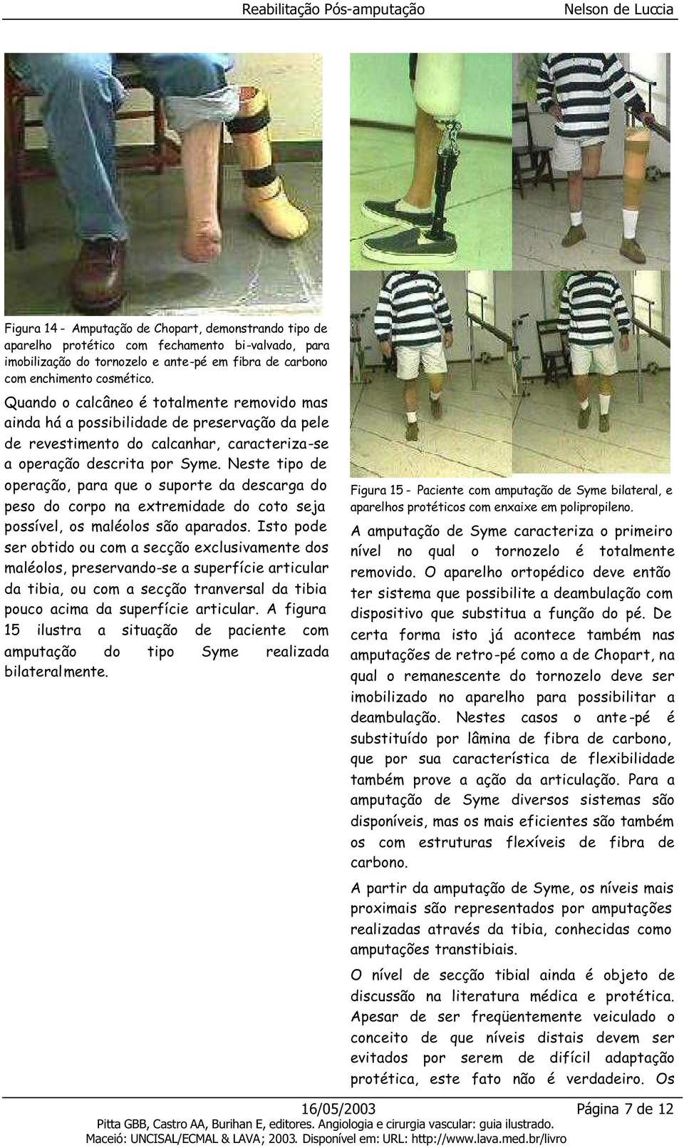 Neste tipo de operação, para que o suporte da descarga do peso do corpo na extremidade do coto seja possível, os maléolos são aparados.