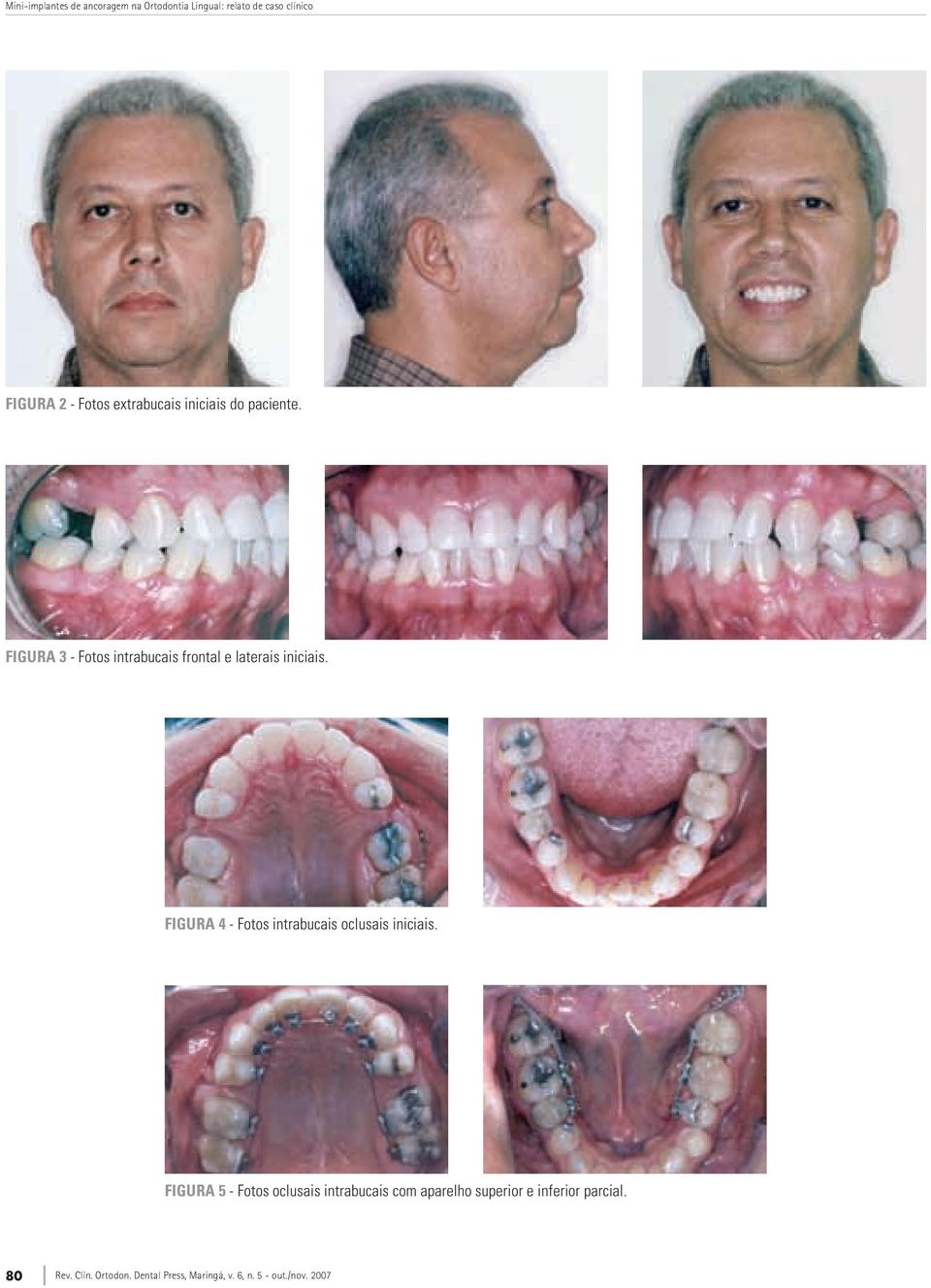 FiGurA 3 - Fotos intrabucais frontal e laterais iniciais.